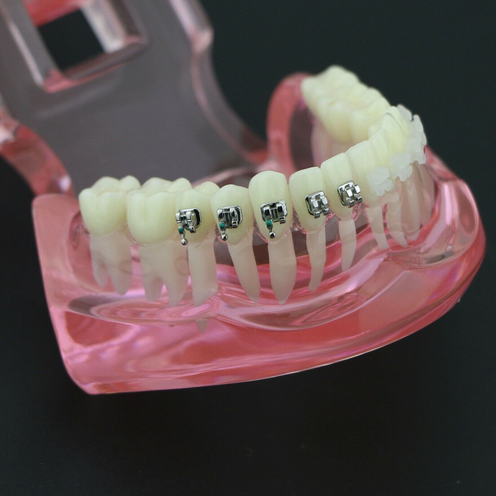 Dental Orthodontic Demonstration Ceramic and Metal Bracket Study Typodont Model