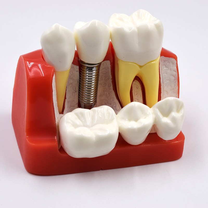 Dental Implant Analysis Crown Bridge Demonstration Teeth Study Model Typodont
