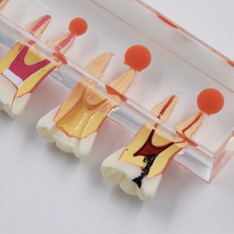 Dental Caries Disease M4018 Study Teaching Model Tooth Correcting Malocclusion