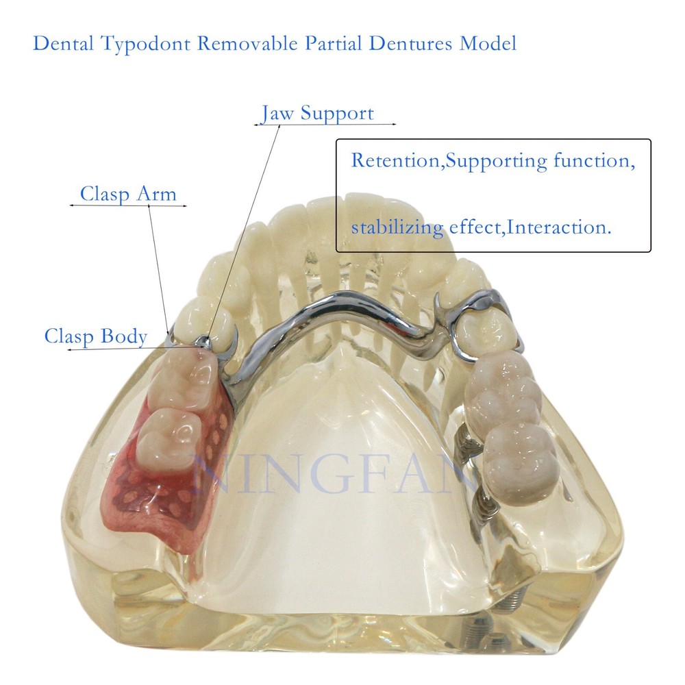 Dental Typodont partial denture Model RPD Demo Retainer WIth 2 Implants