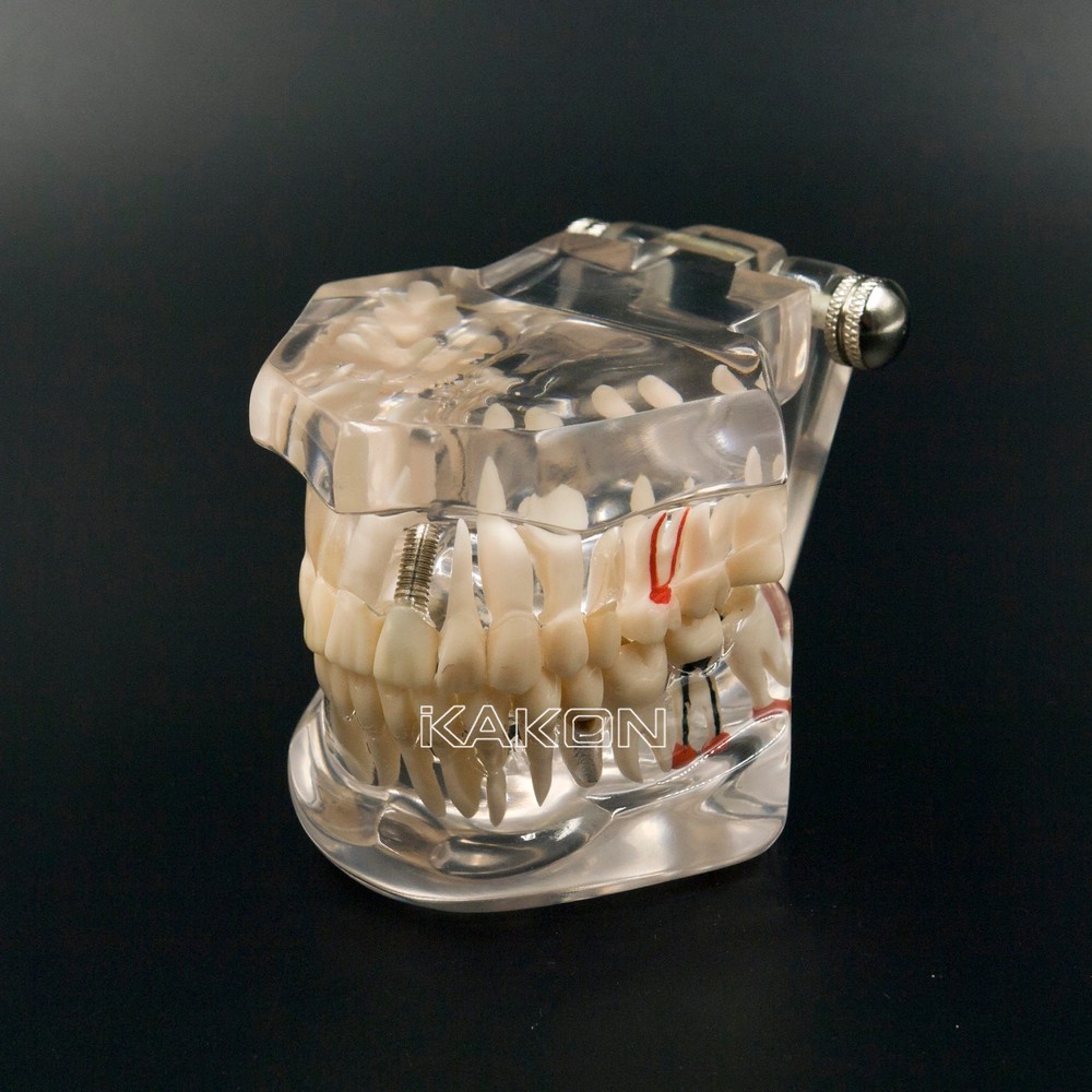 Dental Implant and Restoration Model Transparent Pathological Teeth Study Model