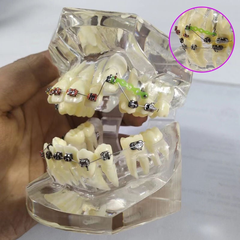 Dental Typodont Orthodontic Treatment Malocclusion Study Model w Brackets Chain