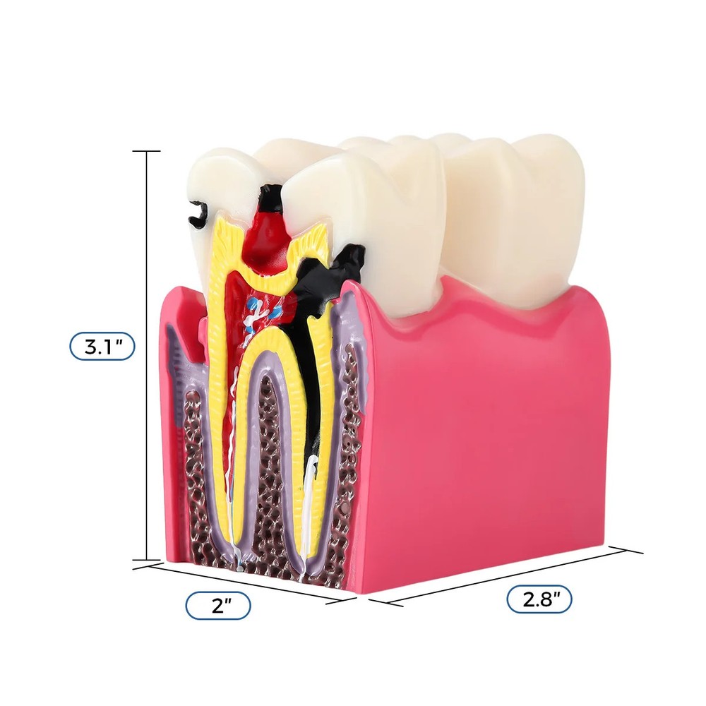 Dental Tooth Model Analysis Crown Bridge Demonstration Removable Caries Study