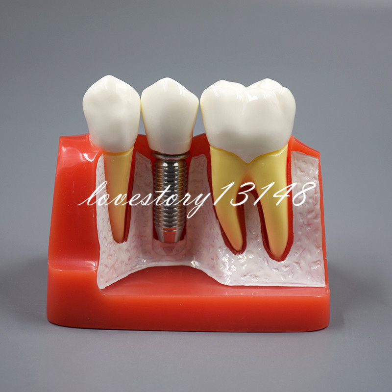 Dental Implant Analysis Crown Bridge Demonstration Teeth Tooth Study Model