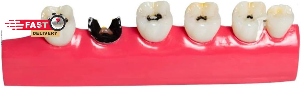 6-Stage Dental Caries Development Model - Anatomical Teeth Decay Demonstration w