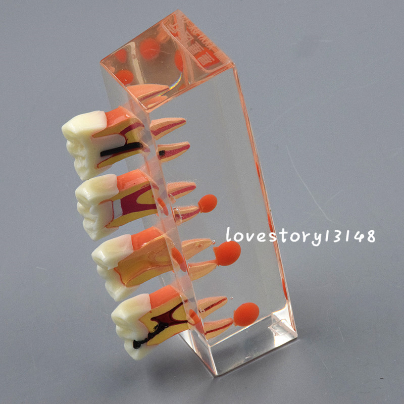1 Set Dental Teeth Model #4018 01 - 4-Stage Endodontic Treatment Study Model
