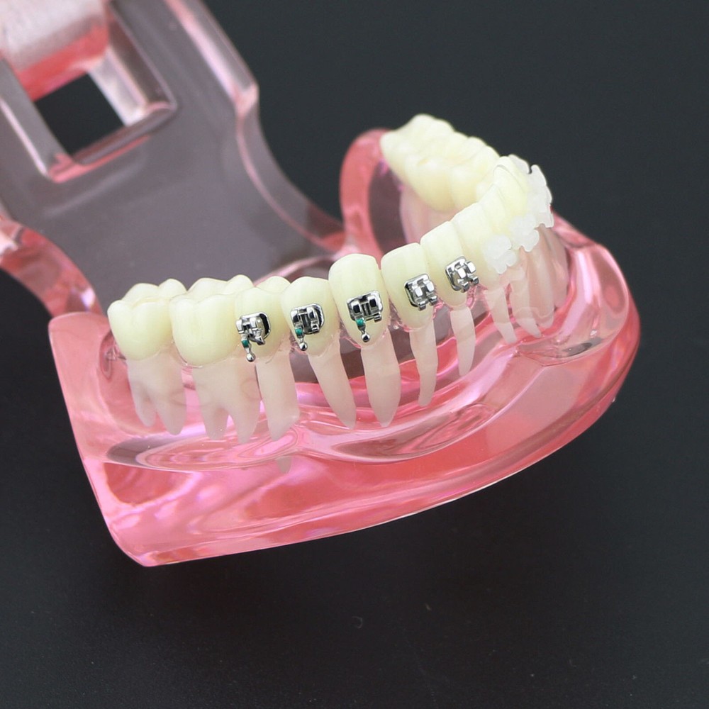 Dental Orthodontic Demonstration Ceramic and Metal Bracket Study Typodont Model