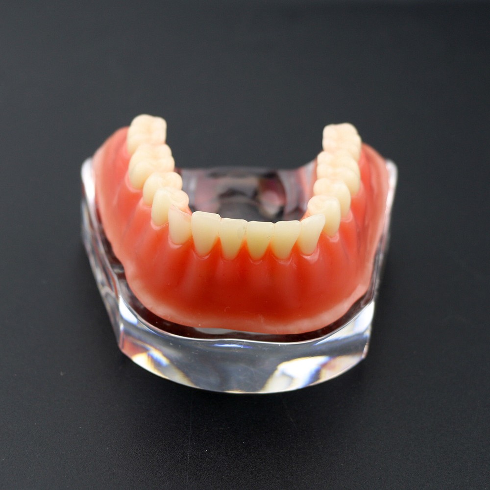 Dental Overdenture Study Demo Model Inferior M6008 Lower 4implants Silver Teeth