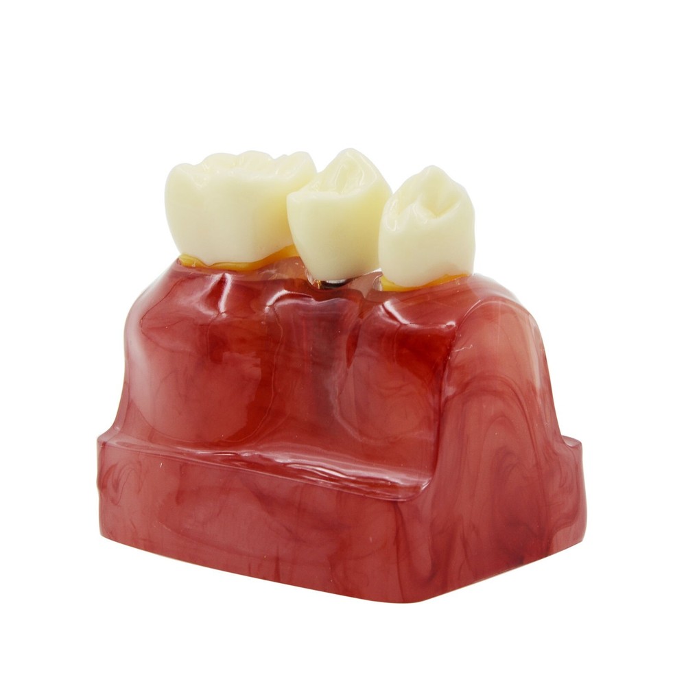 Dental Demonstration Teeth Tooth Model Typodont Implant Analysis Crown Bridge