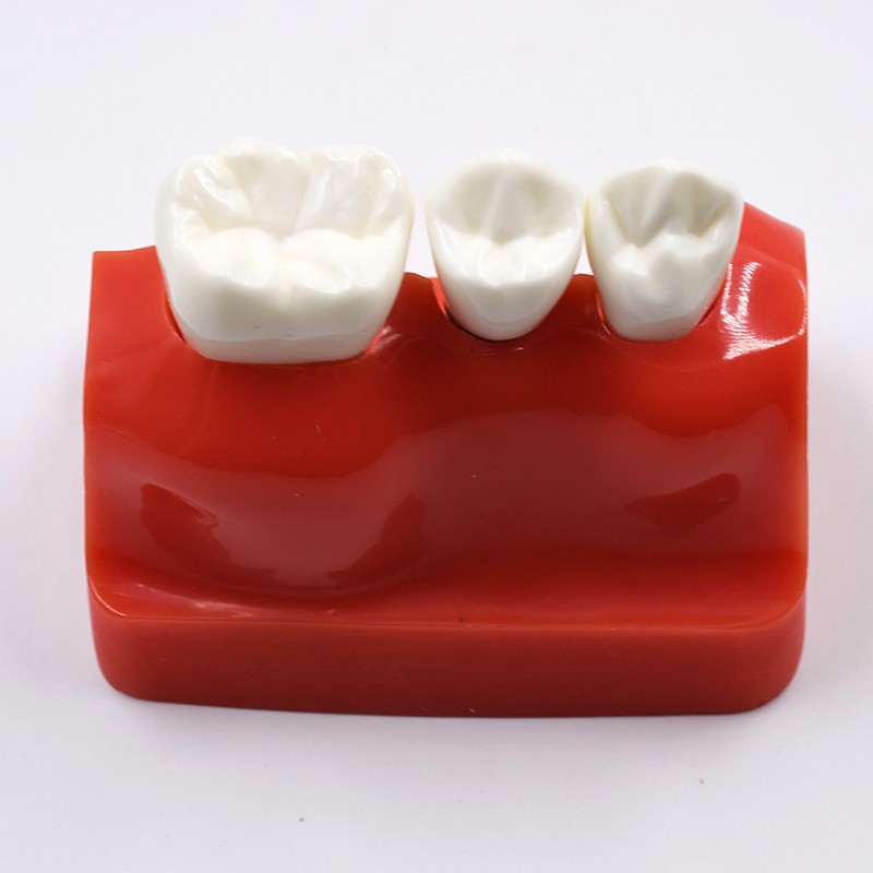Dental Implant Analysis Crown Bridge Demonstration Teeth Study Model Typodont