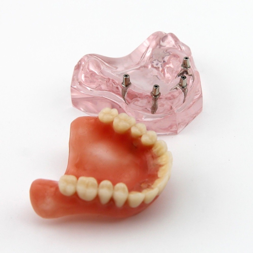 Dental Implant Demo Model Overdenture 4 Implants Maxillary Upper Superior