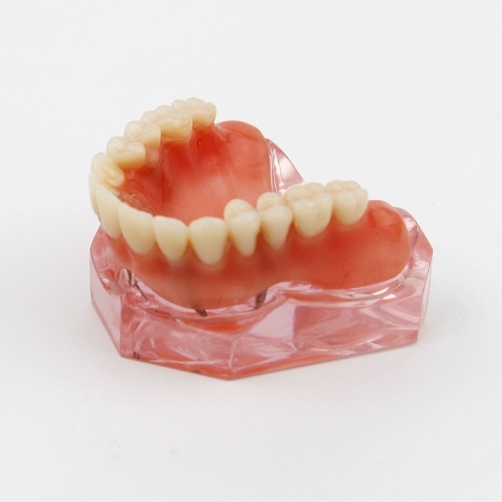 Dental Implant Demo Model Overdenture 4 Implants Maxillary Upper Superior