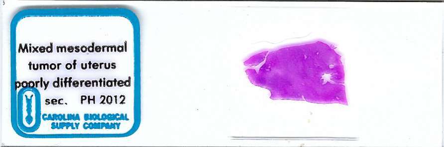 Human Mixed Mesodermal Tumor of Uterus Pathology Microscope Slide