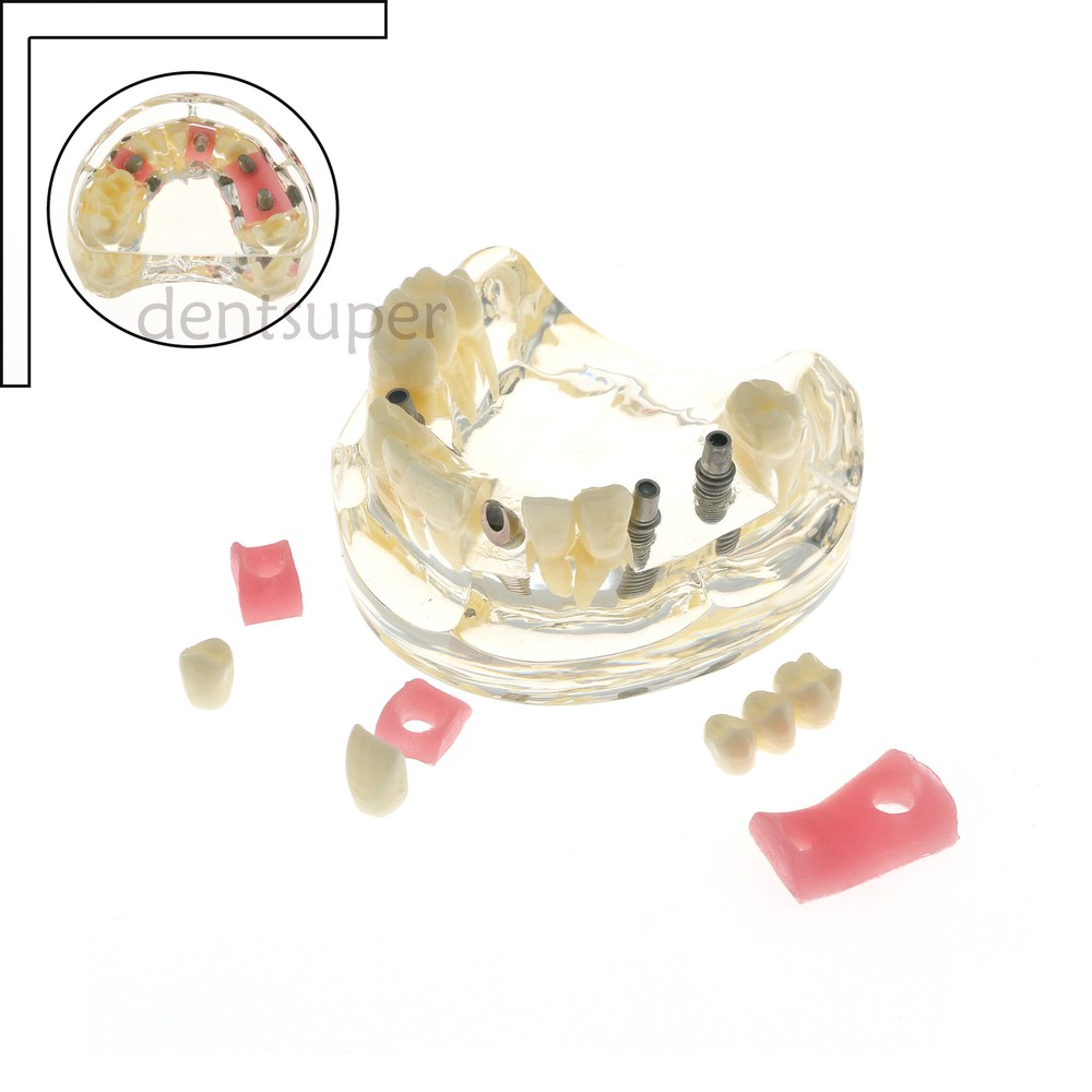 Dental Multiple Types Teaching Teeth Model Typodont Ortho Implant Practice Demo