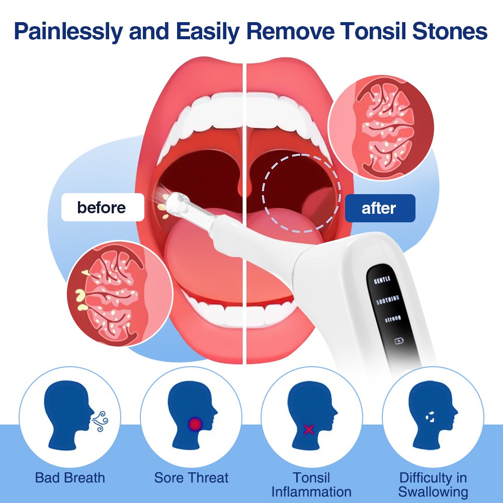 Electronic Tonsil Stone Remover Vacuum Kit with 3 Suction Levels, LED Light
