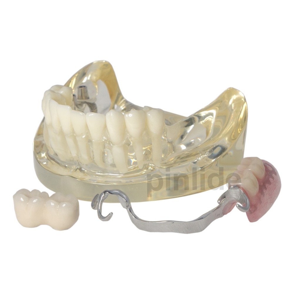 Dental Typodont Restoration Model With 2 Implants Partial Denture Demo M6022