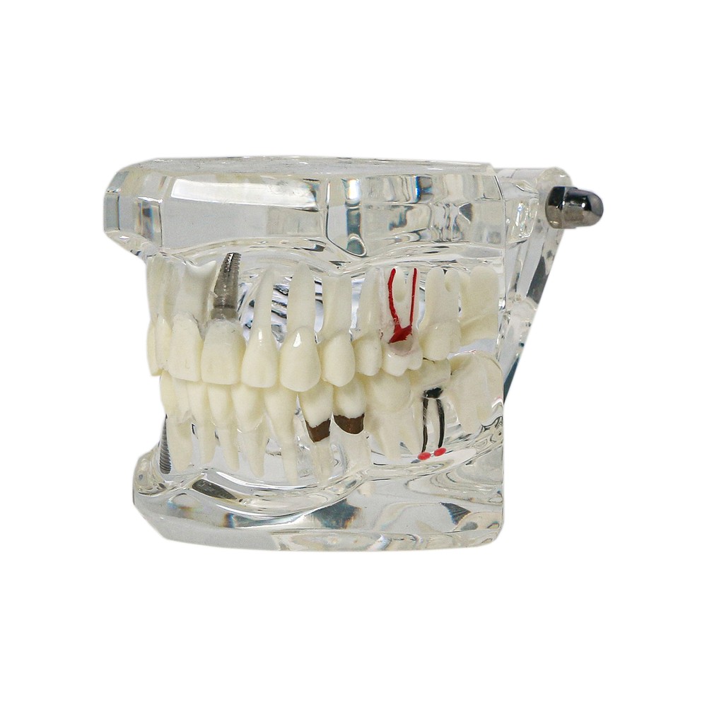 Dental Implant Teeth Model Restoration Pathology Teach Study Demo Removable