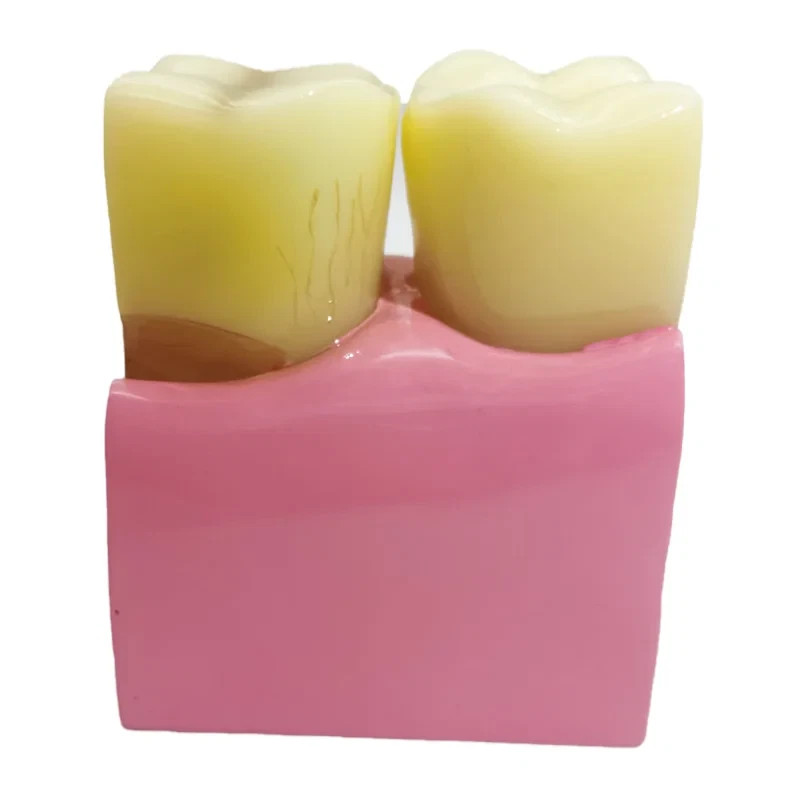 Dental Caries Disease Model Periodontitis Case Analysis Study Demo Teeth Model