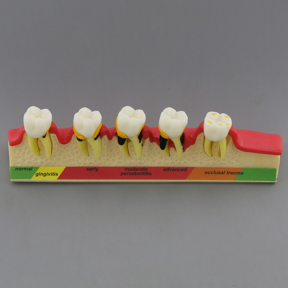 Dental Study Teaching Model Periodontal Disease Assort Teeth Dentoform Typodont