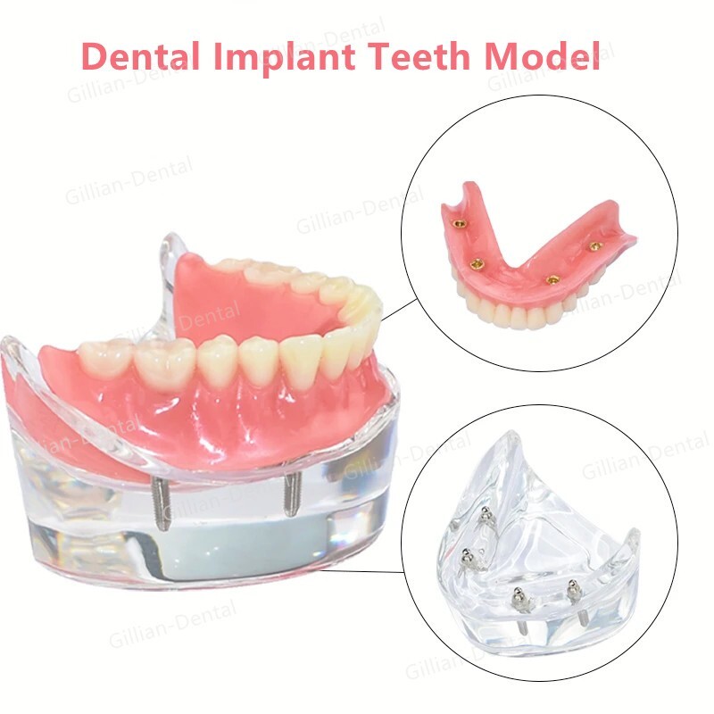 Dental Study Teach Teeth Model With Overdenture Inferior Demo 4 Implants