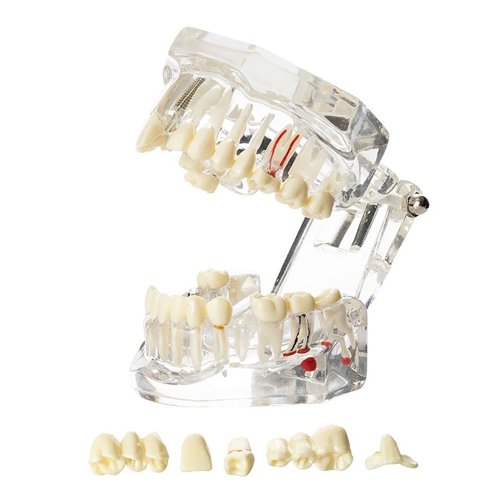 Dental Implant Disease Study Teaching Teeth Model Restoration Bridge Tooth Analy