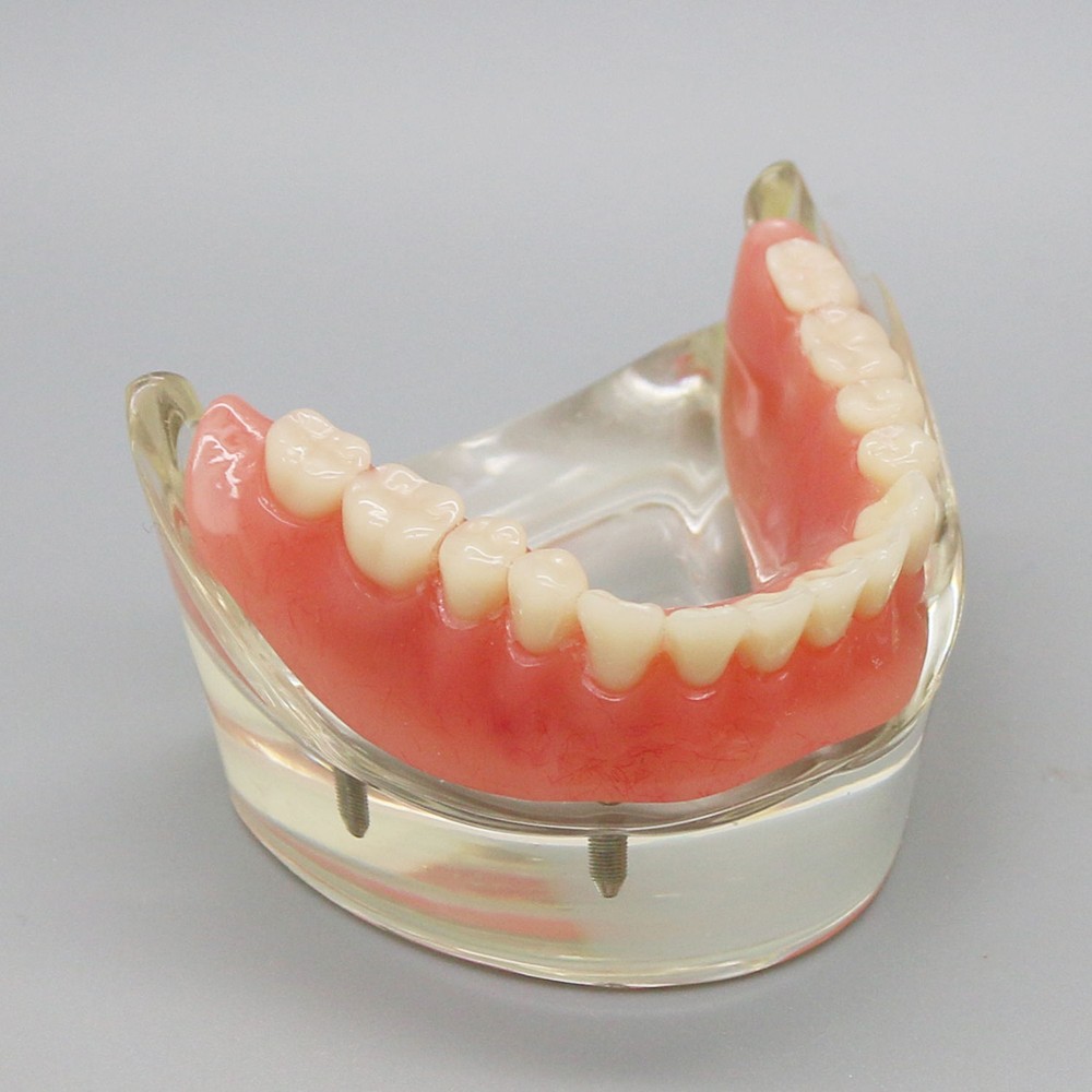 Dental Oral Transparent Upper Teeth 2/4 Implants Model Overdenture Restoration