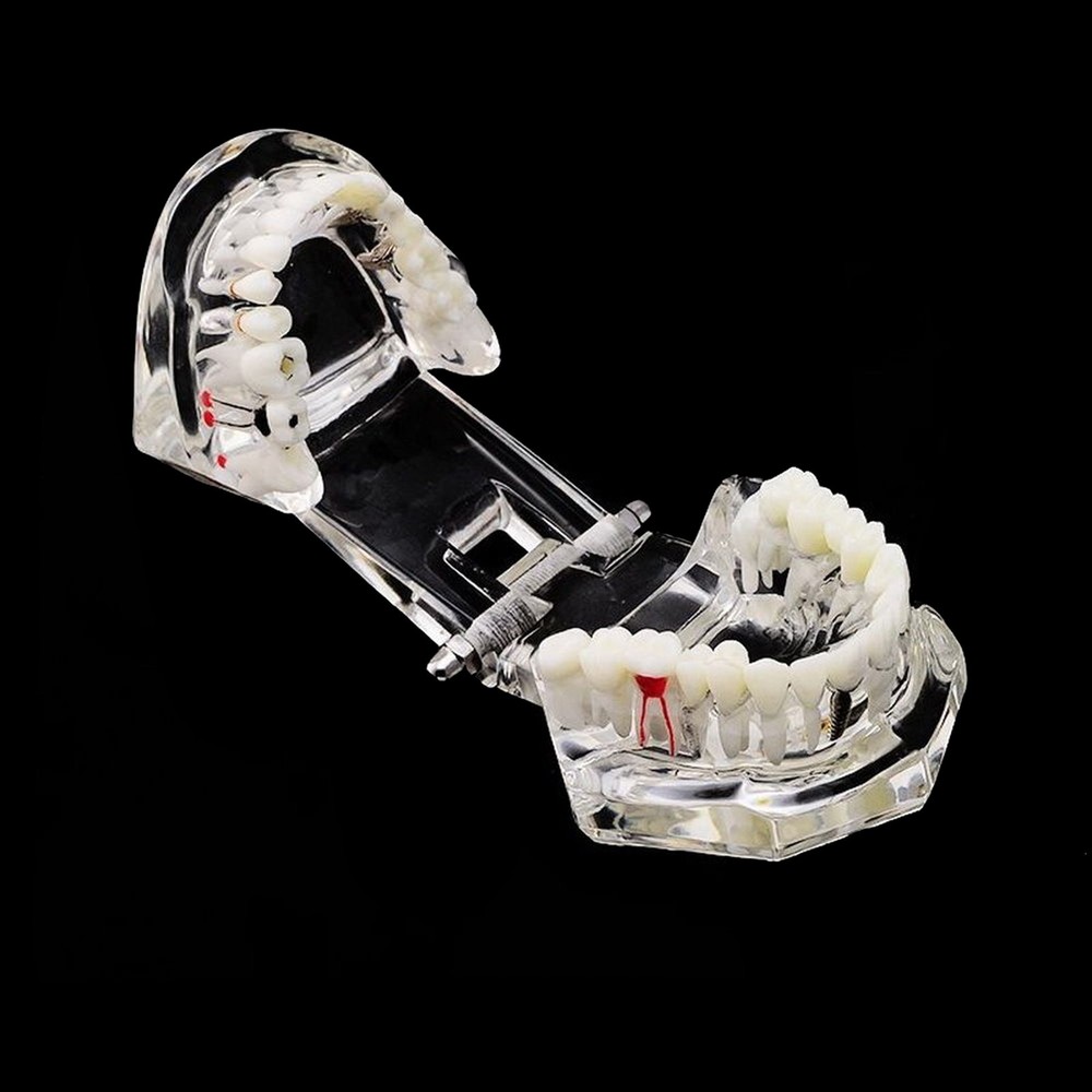Dental Implant Disease Study Teaching Teeth Model Restoration Bridge Tooth Analy
