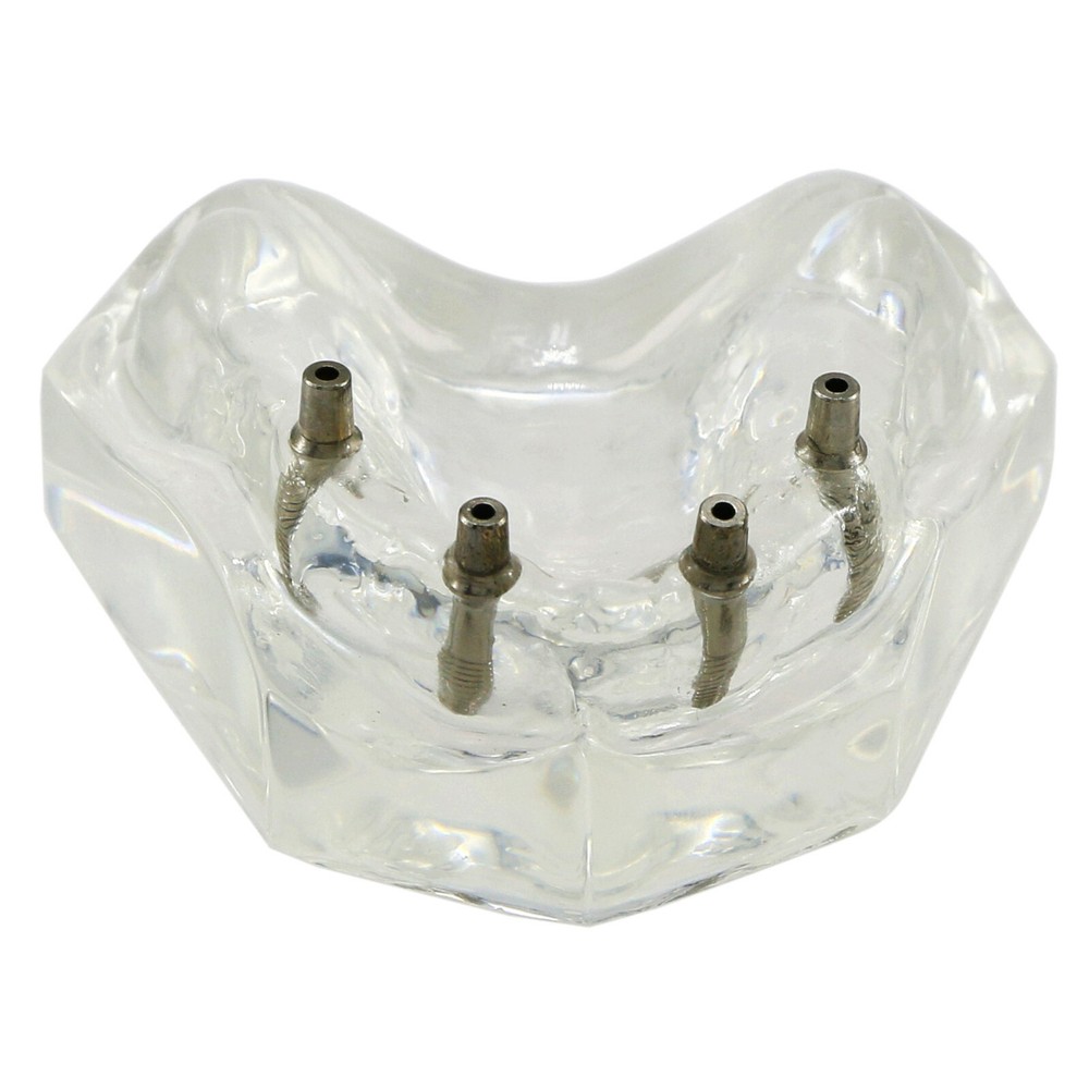 Dental Typodont Teeth Model 4 Implants Upper Overdenture Superior M6001 Clear