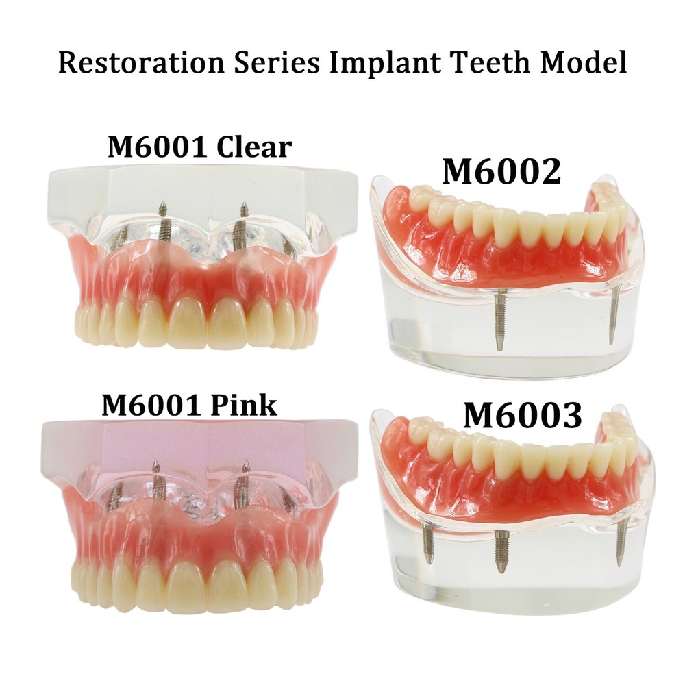 Detal Typondont Restoration Implant Overdenture Teeth Model 2 4 Implants