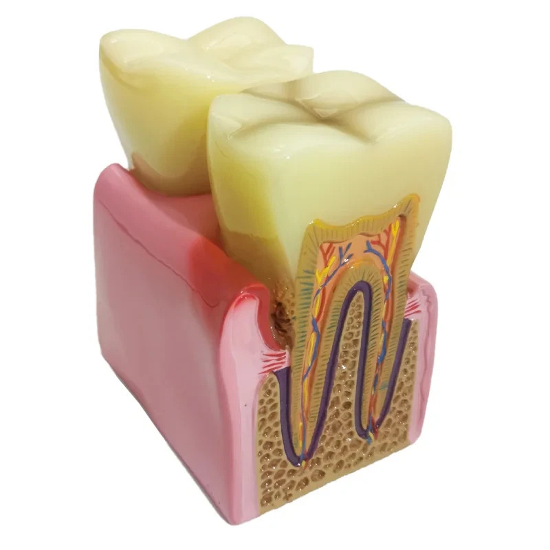 Dental Caries Disease Model Periodontitis Case Analysis Study Demo Teeth Model