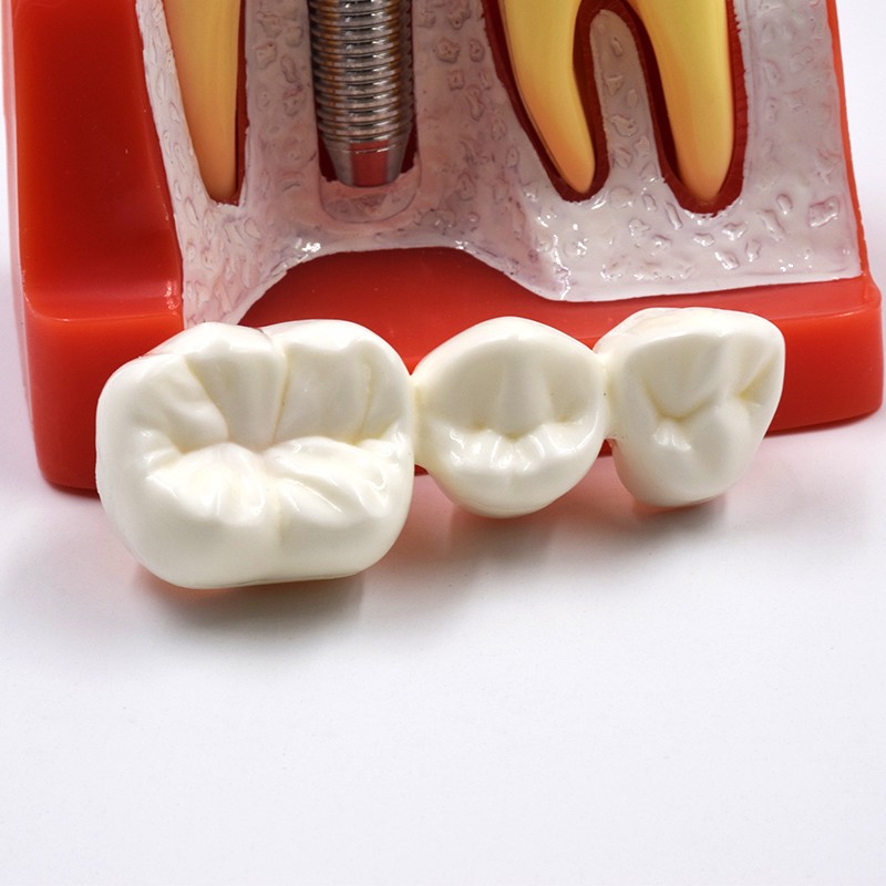 Dental Implant Analysis Crown Bridge Demonstration Teeth Study Model Typodont