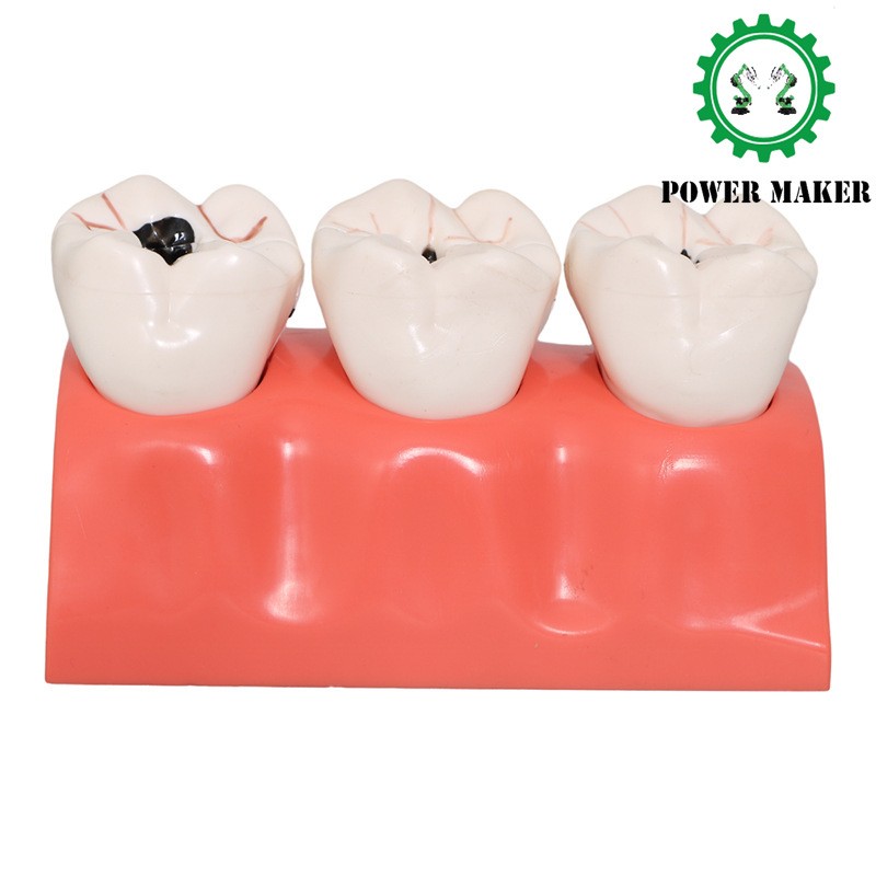 3 Stage Dental Caries Development Model Dental Model Caries Disintegration Model