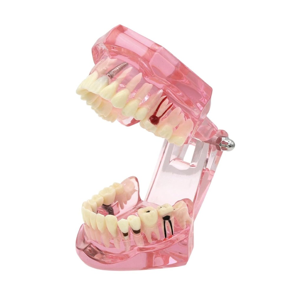 Dental Multi Typodont Teeth Model for Implant Pathological Restoration Practice
