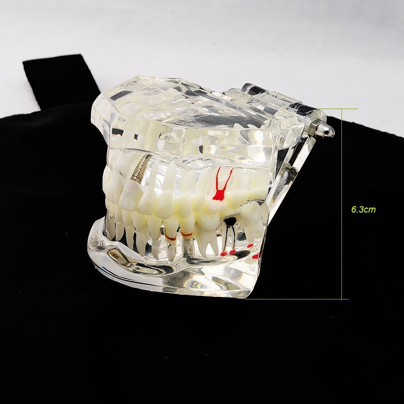 Dental Teeth Model With Restoration&Bridge Implant Disease Study Teaching Model