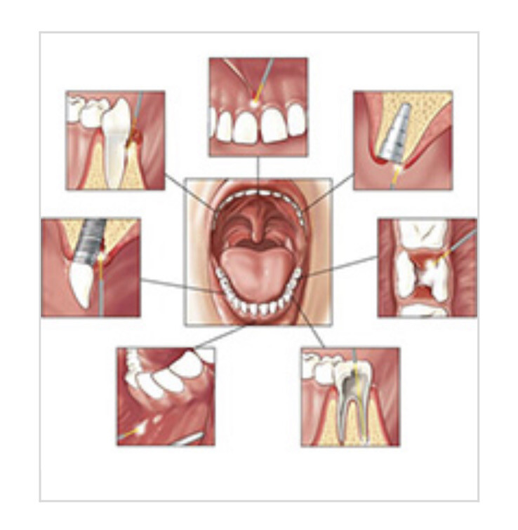 1x dental soft tissue laser diode