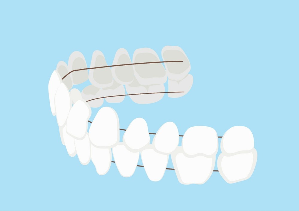 DIY Dentures - Preformed Resin Teeth (upper and lower)