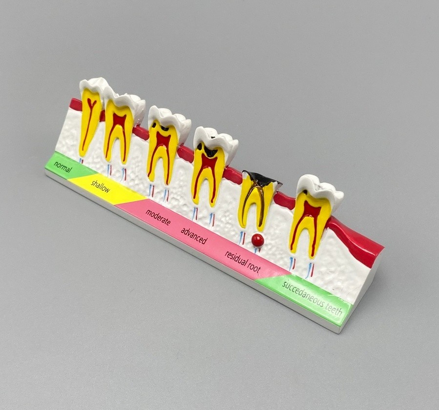 Dental Caries Disease Models Dentoform Typodont Study Teaching Teeth Model Demo