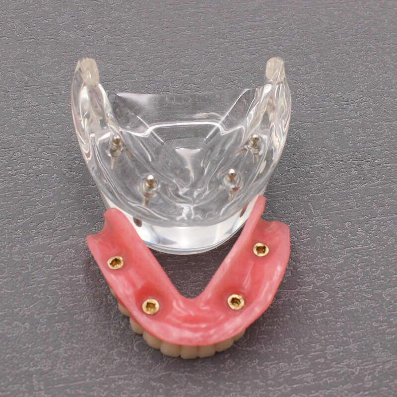 Dental Tooth Model Brushing Training Practice Implant Overdenture Restoration