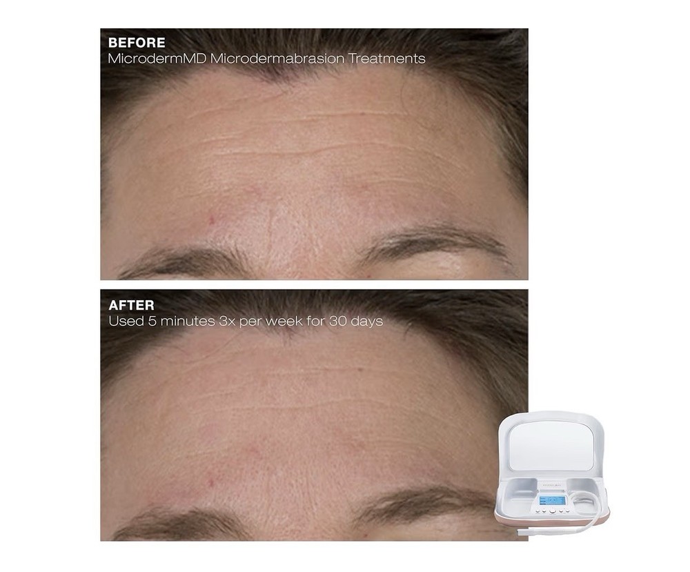 Trophy Skin MicrodermMD - At Home Microdermabrasion Kit -
