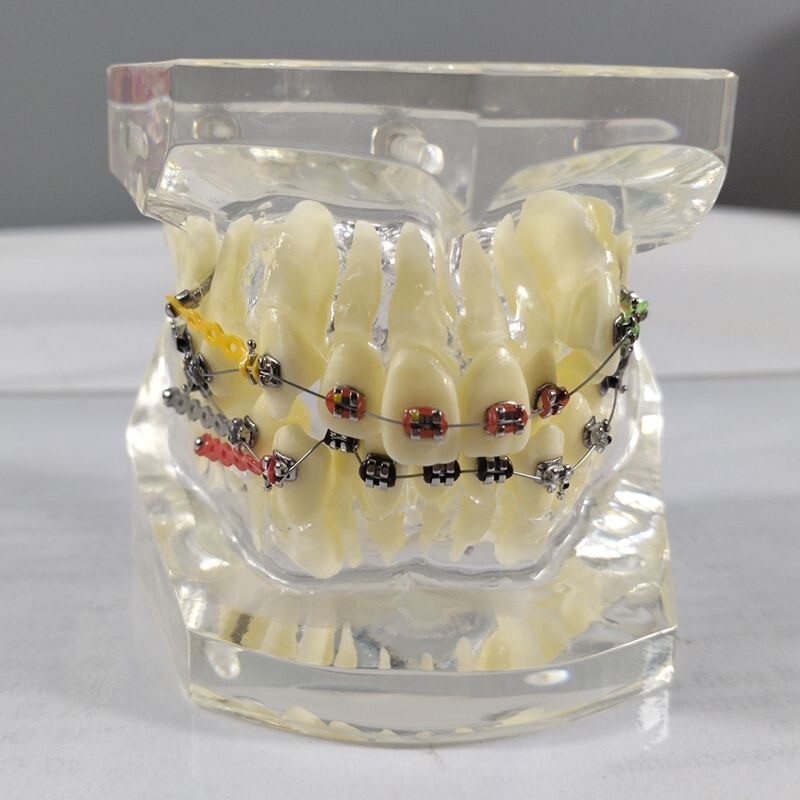 Dental Typodont Orthodontic Treatment Malocclusion Study Model w Brackets Chain