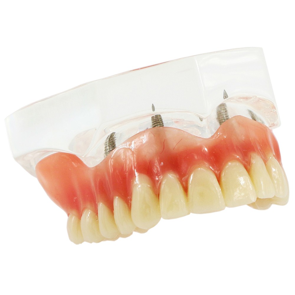 Dental Typodont Teeth Model 4 Implants Upper Overdenture Superior M6001 Clear