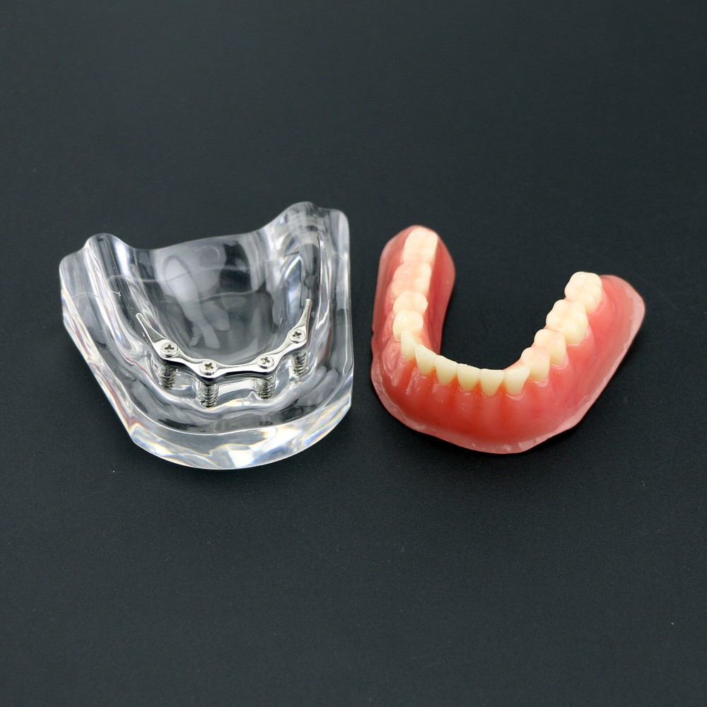 Dental Teeth Model Inferior Overdenture Precision 4 Implants Demo Silver Bar