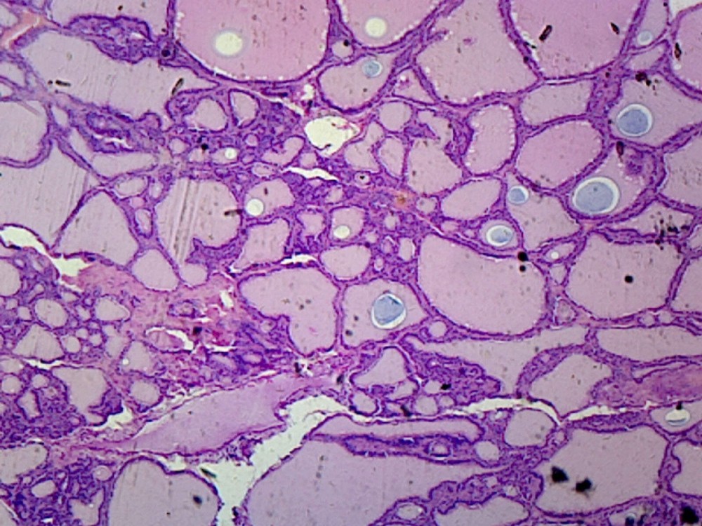 Goiter (Human Endocrine System); Section; H&E Stain
