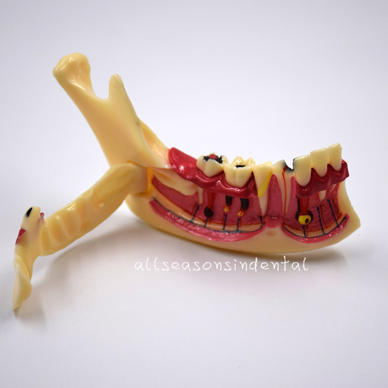 1 Pcs Dental Mandibular Tissue Teeth Anatomical Model Patient Teach Study Model