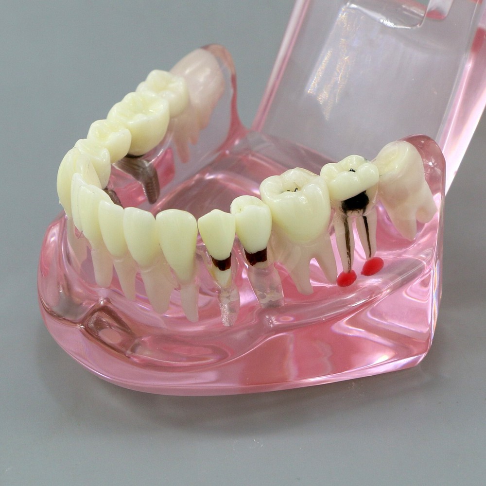 Dental Implant Disease Study Teaching Teeth Model Restoration Bridge Tooth Analy