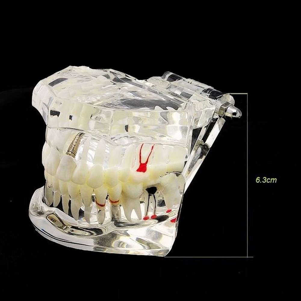 Dental Implant Disease Study Teaching Teeth Model Restoration Bridge Tooth Analy