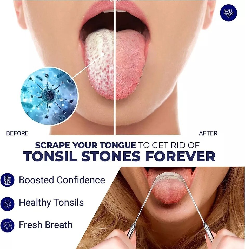 Tonsil Stone Remover | Tonsil Stone Removal Kit | Tonsil Stone Treatment