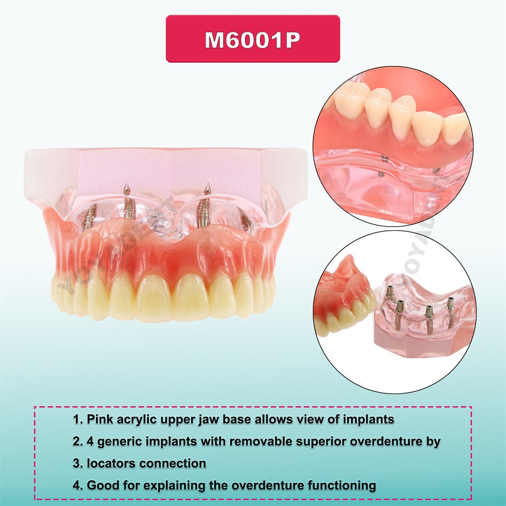 US Dental Implants Teeth Model Upper Lower Jaw 4/6 Overdenture Practice Demo