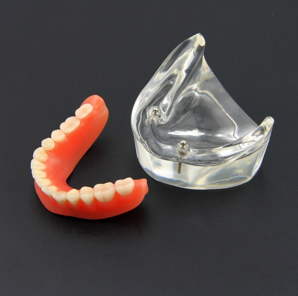 Dental Inferior Overdenture Anatomical Model Teeth Typodont Lower Jaw 2 Implants