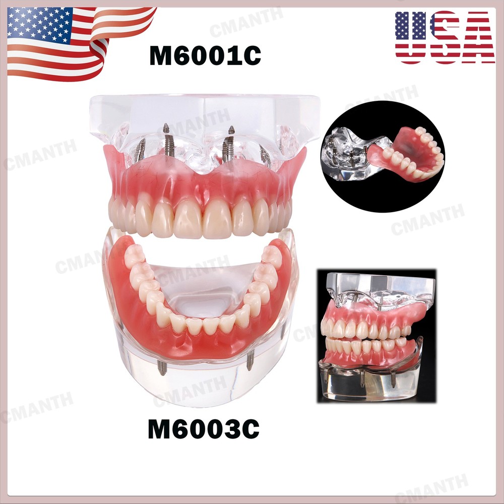 US Dental Model Removable Overdenture Teeth Upper/Lower Jaw 4 Implants Model